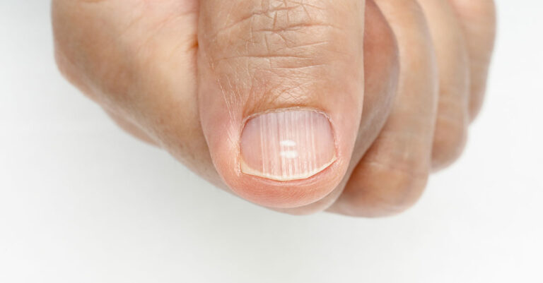 Fingernail_Dent_1200