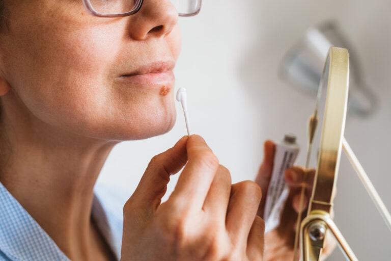 A woman looking her face in a mini mirror before applying an antiviral cream or ointment to treat Herpes labialis on her lower lip.