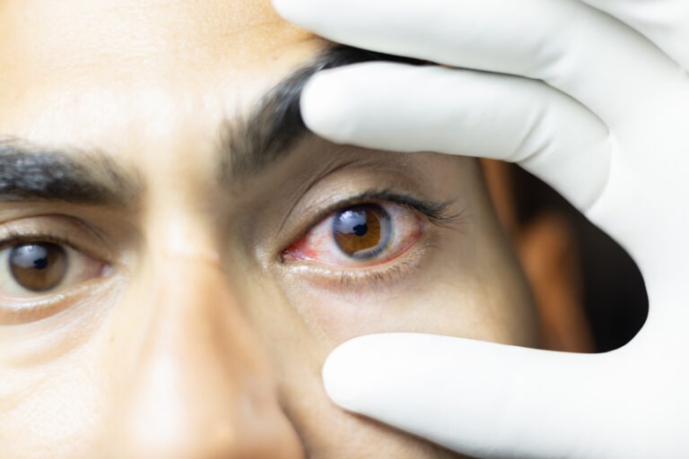 Eye Flue