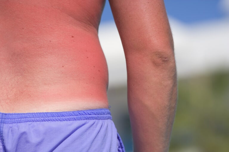 Man with sunburnt back, mid section, close-up