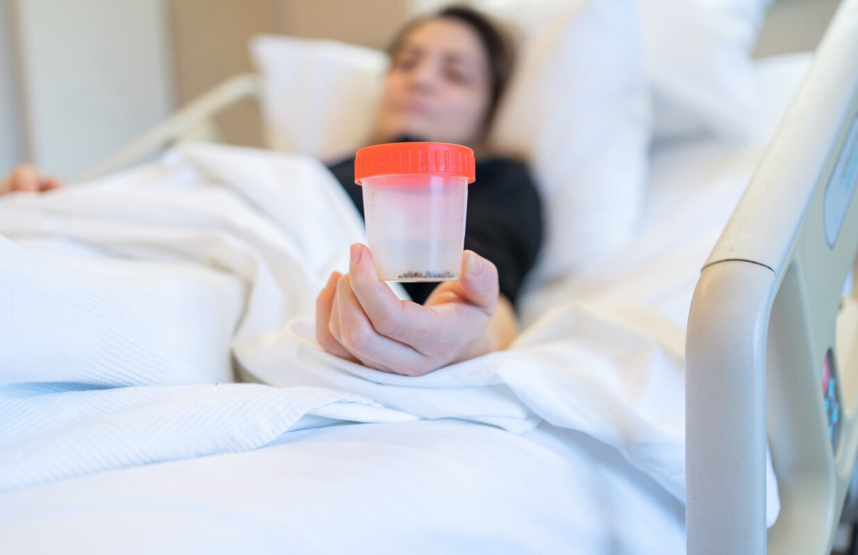 Female Patient Looking Her Gallstones After Surgery Operation