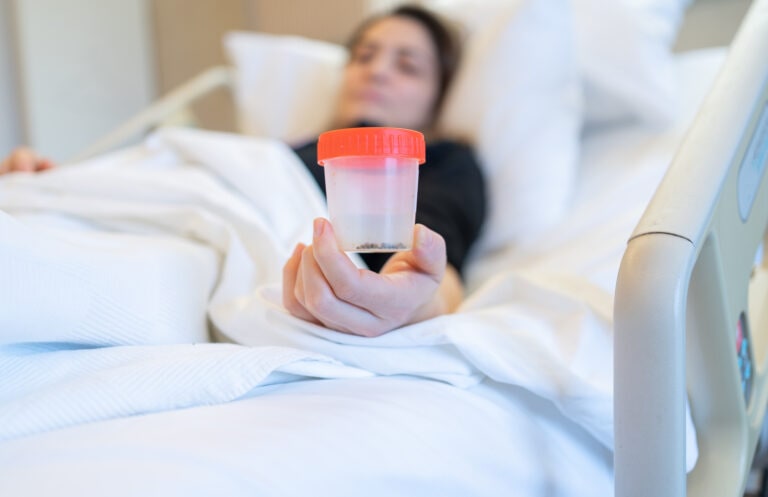 Female Patient Looking Her Gallstones After Surgery Operation