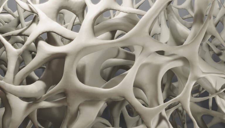 Osteoporosis, illustration