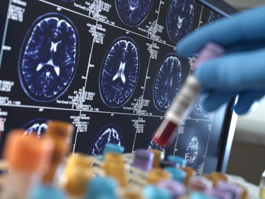 United Kingdom, High Wycombe, Alzheimer's and Dementia Research, Scientist holding a blood sample during a clinical trial with a MRI on screen