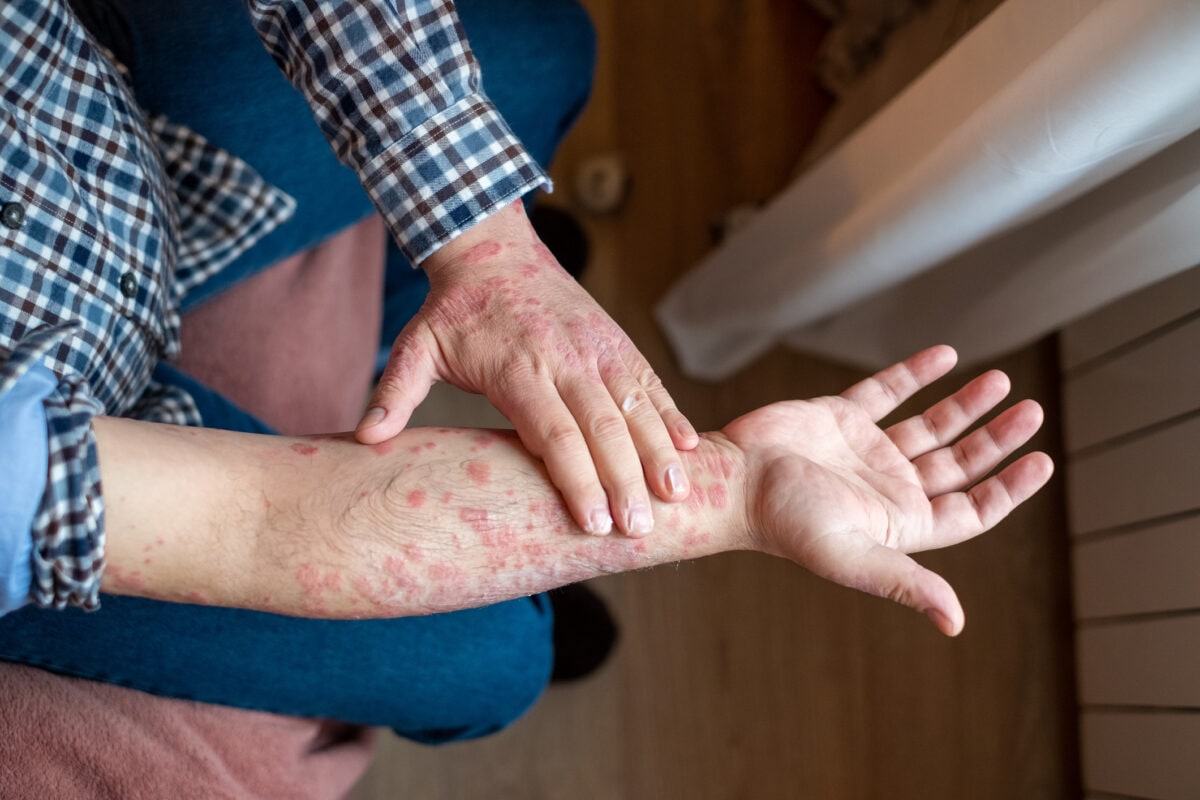 adult skin problem