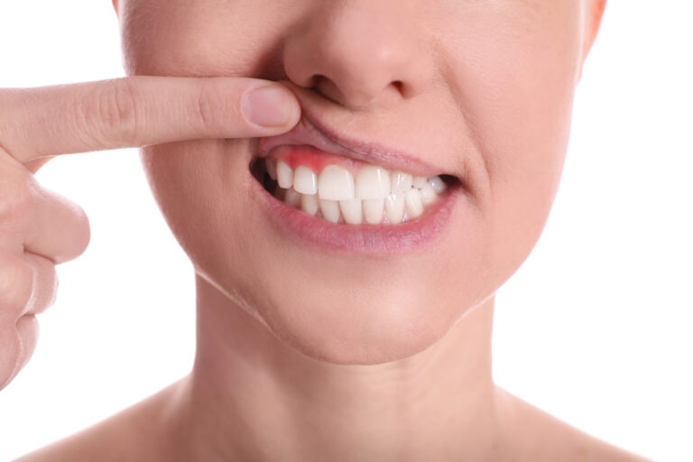 Woman showing inflamed gums on white background, closeup view