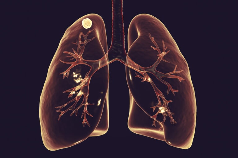 Apical nodule, secondary tuberculosis infection, illustratio