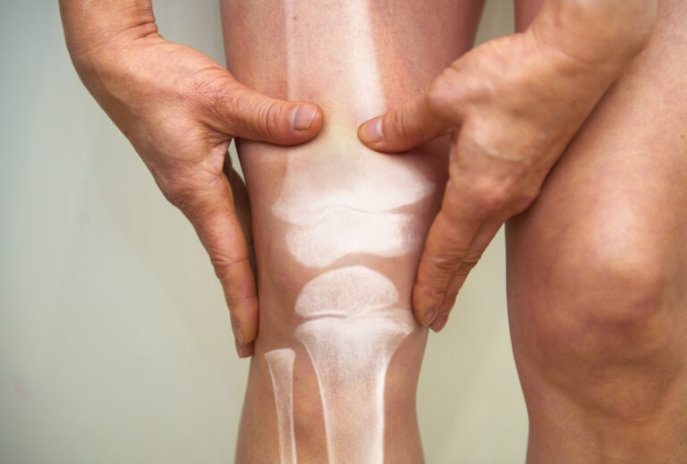 X-ray of knee - osteoarthritis and rheumatoid arthritis