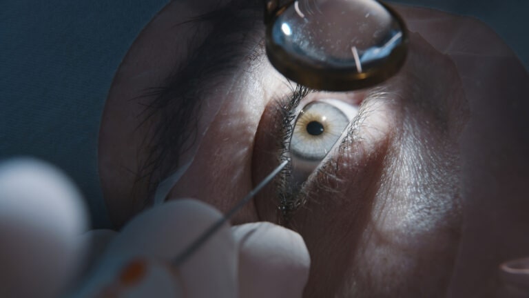 Close-up. Patient and surgeon in operating room during ophthalmic surgery or diagnosis. Open eye. Patient under sterile cover.
