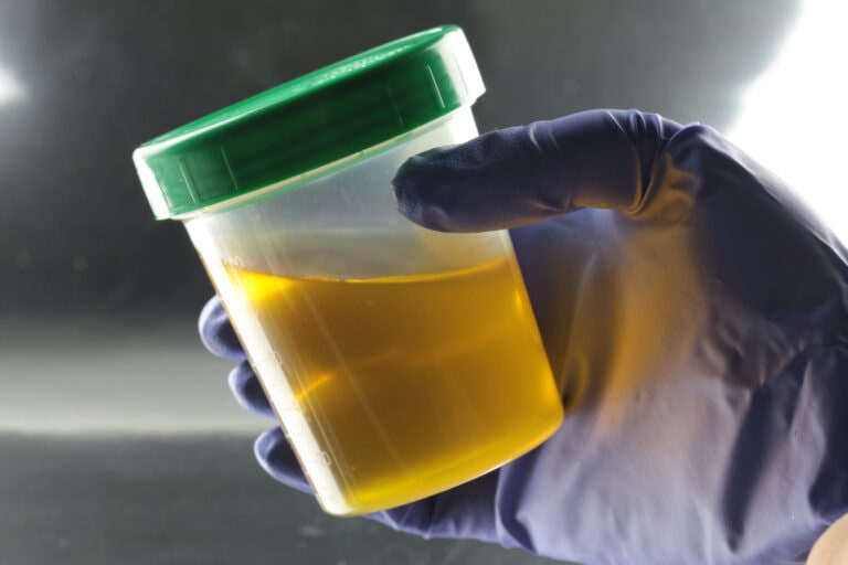 Human urine sample in a sealed container