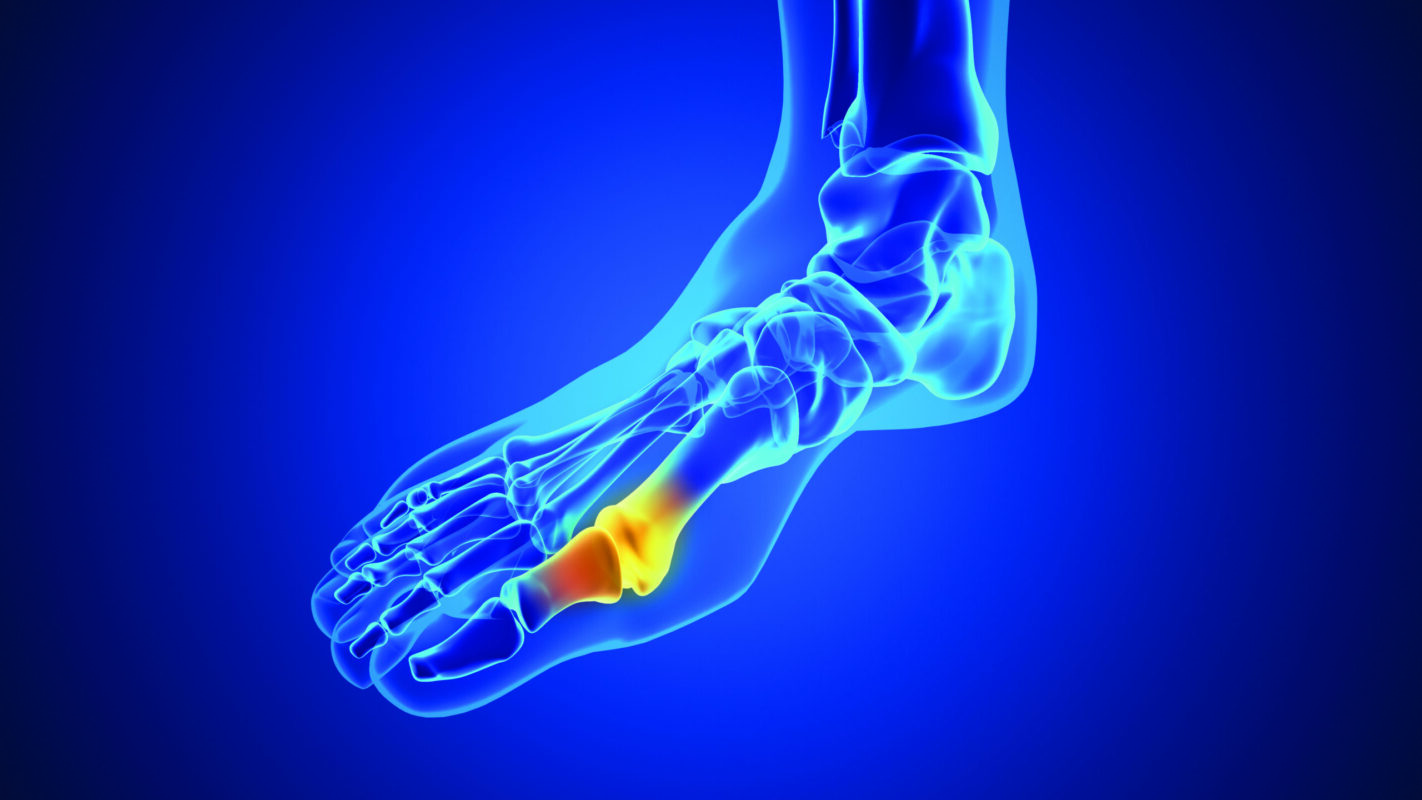 Painful gout inflammation on big toe joint