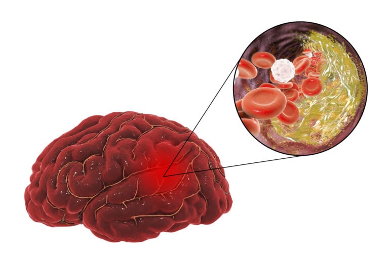 Stroke due to atherosclerosis, illustration