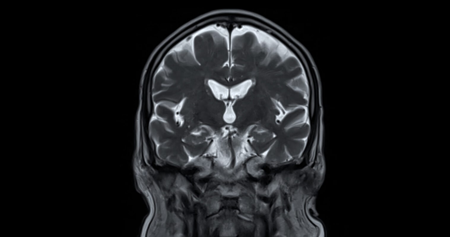 MRI scan of the  brain   for detect  Brain  diseases sush as stroke disease, Brain tumors and Infections.
