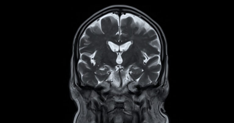 MRI scan of the  brain   for detect  Brain  diseases sush as stroke disease, Brain tumors and Infections.