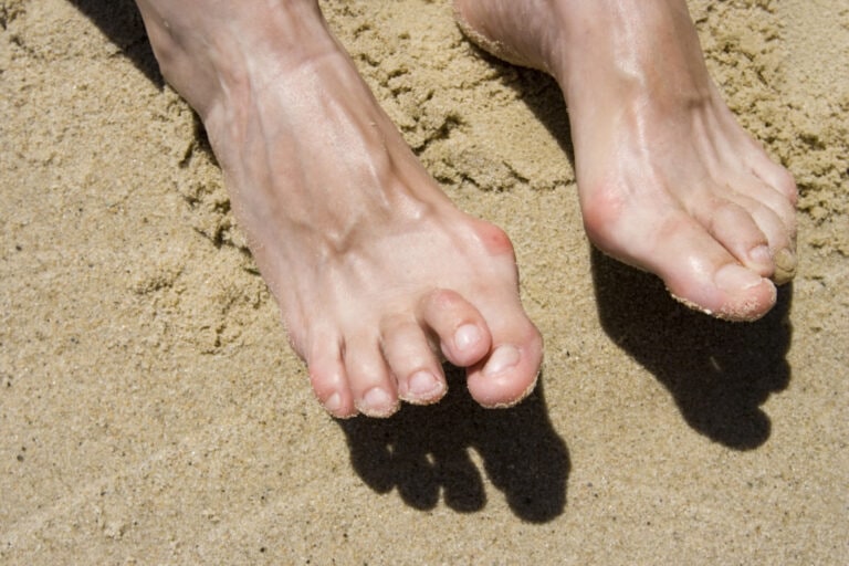 Hammertoe and Bunion