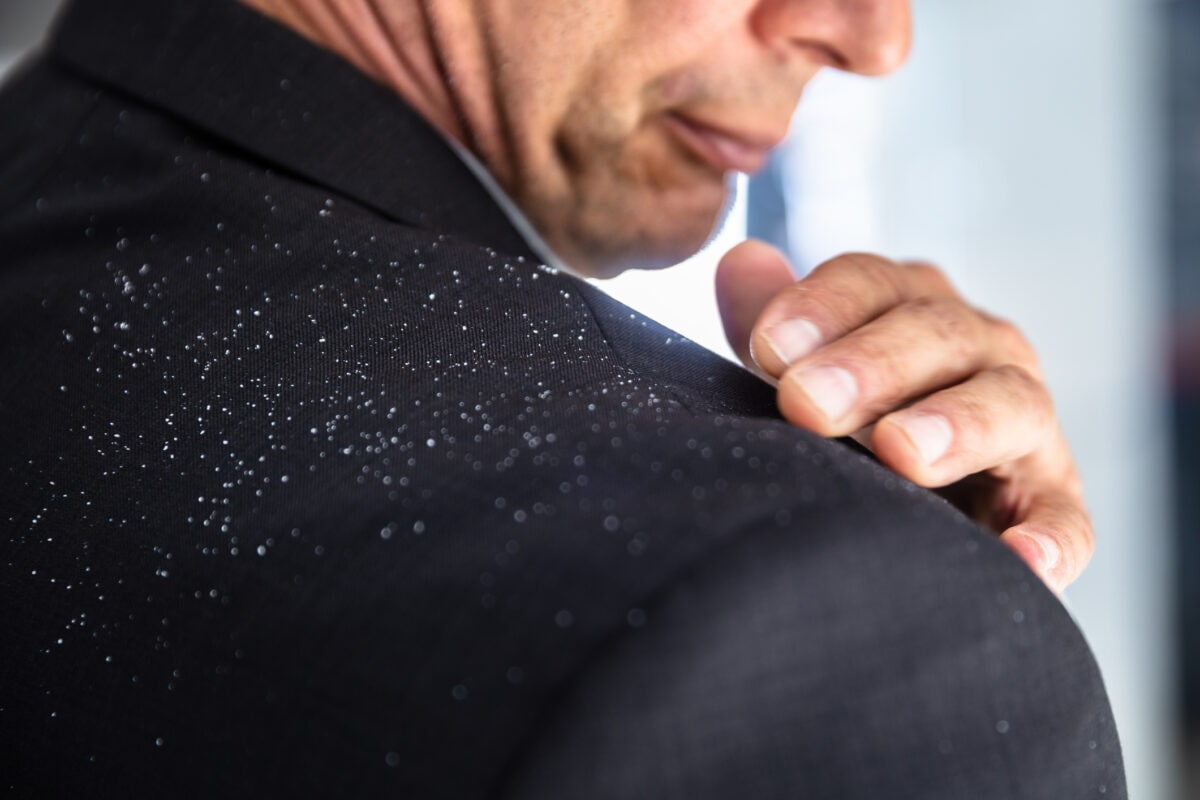 dandruff