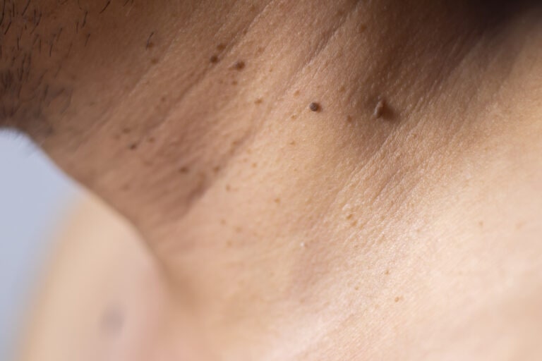 Skin tags or soft tissue tumors that are a skin problem on the neck