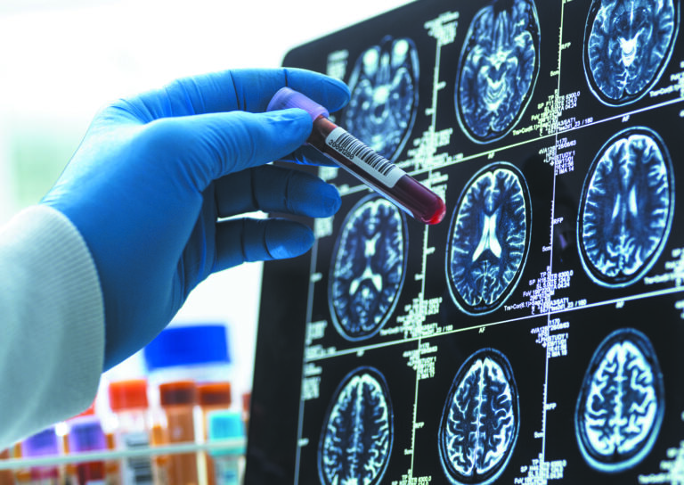 Alzheimer's Blood Test