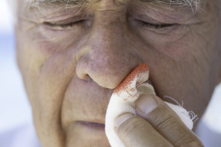 When to worry about a nosebleed