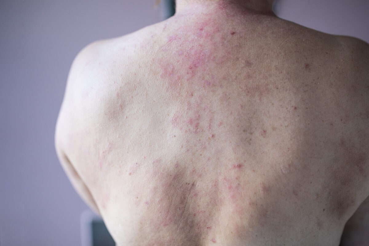 heat rash