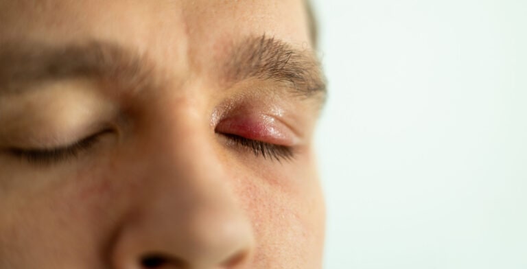 stye