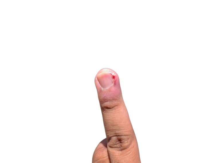 ingrown fingernail