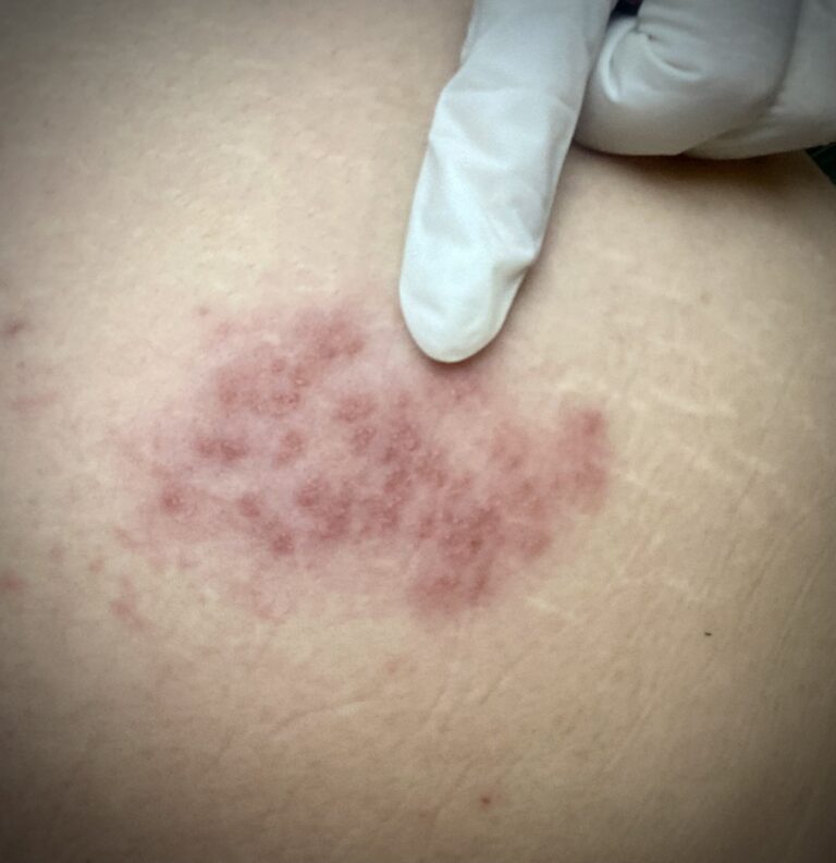 shingles