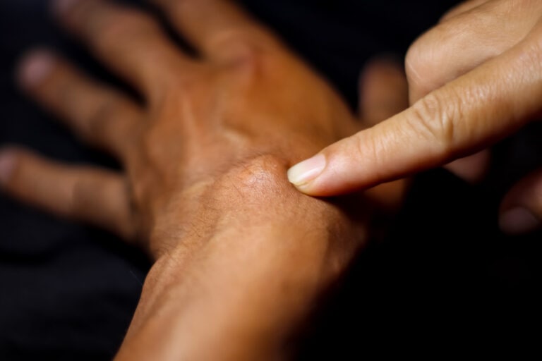 cyst