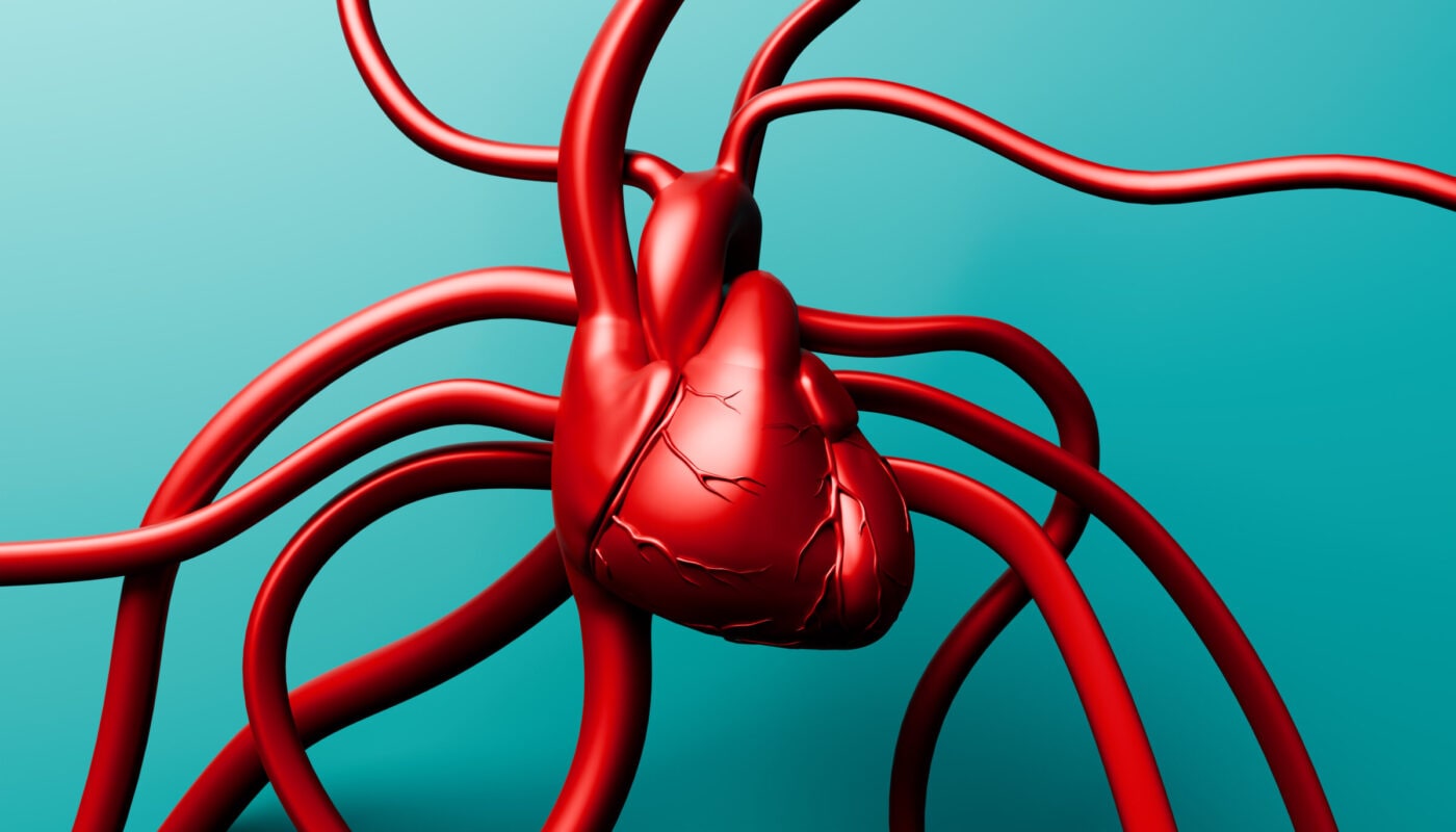 arterial calcification