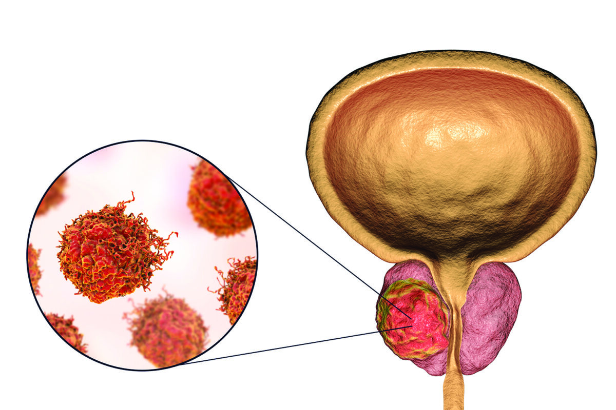 hormone therapy for prostate cancer