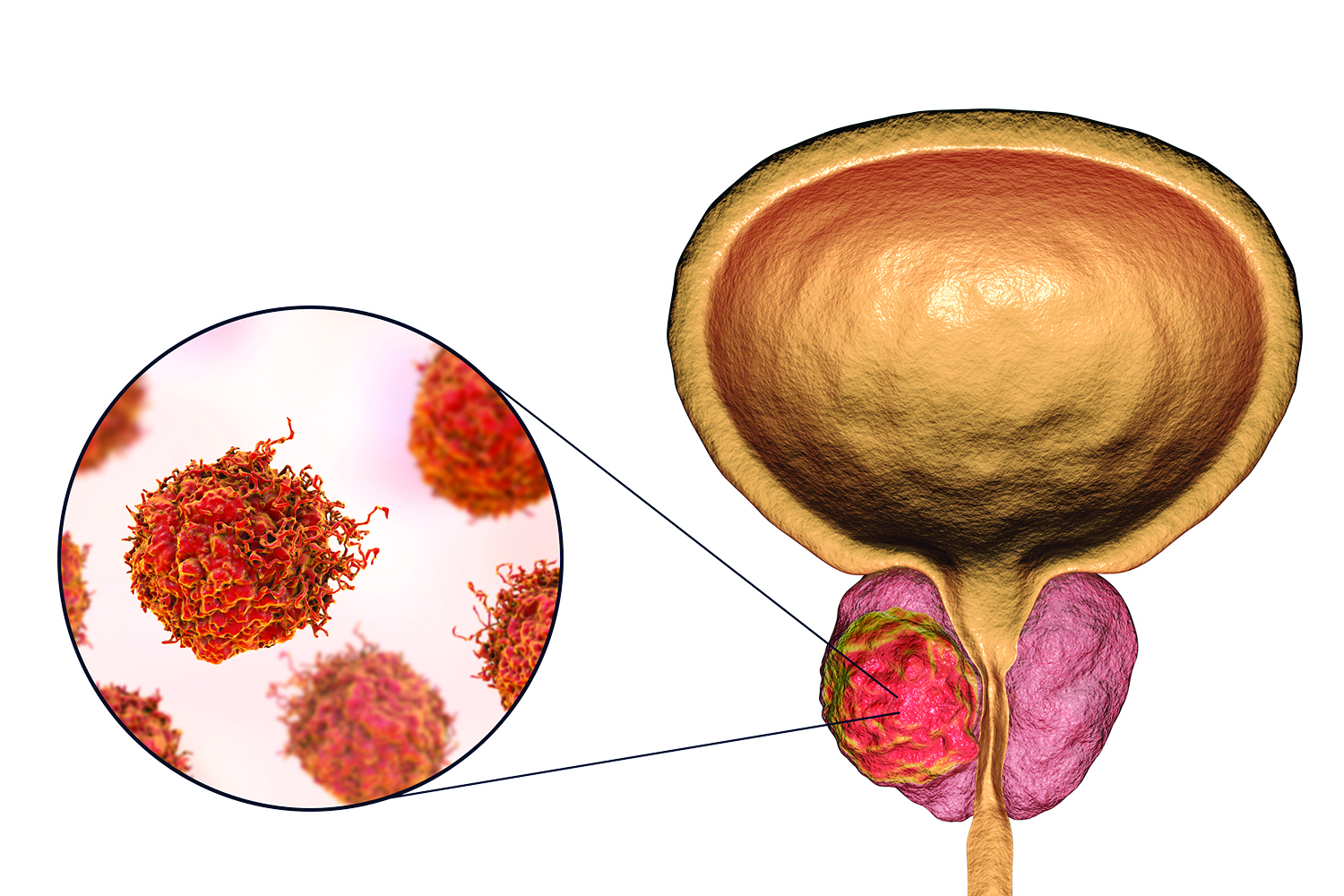 hormone therapy for prostate cancer