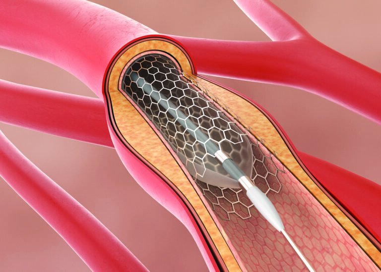 heart stent