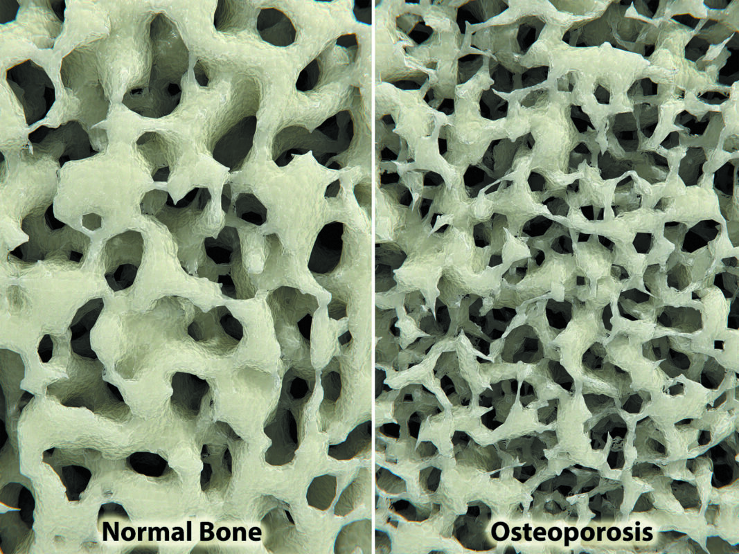 osteopenia