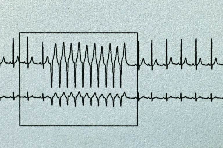 Tachycardia