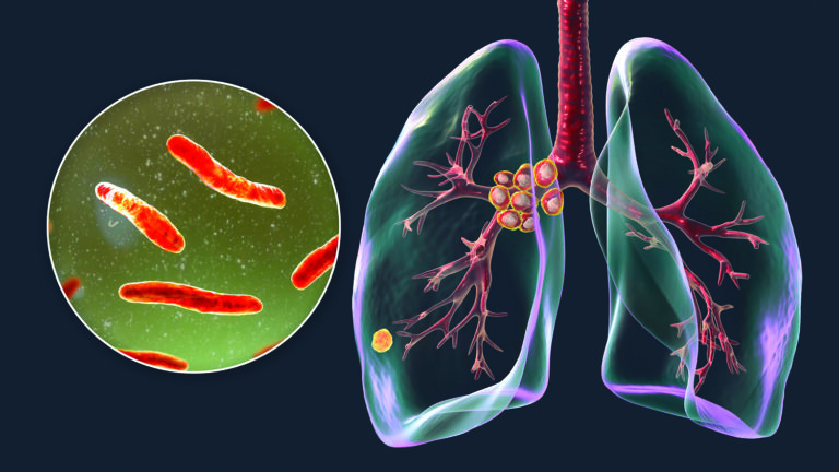 Tuberculosis