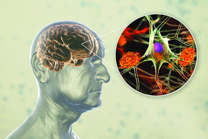 Alzheimer’s Disease Medications