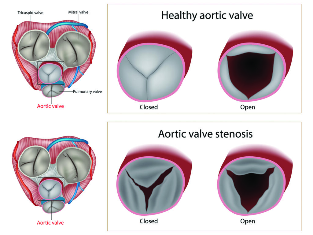 Surgery Often Is the Best Solution for Aortic Valve Stenosis - Bottom ...