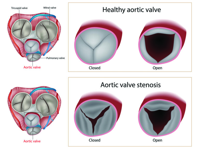 Aortic Valve Stenosis