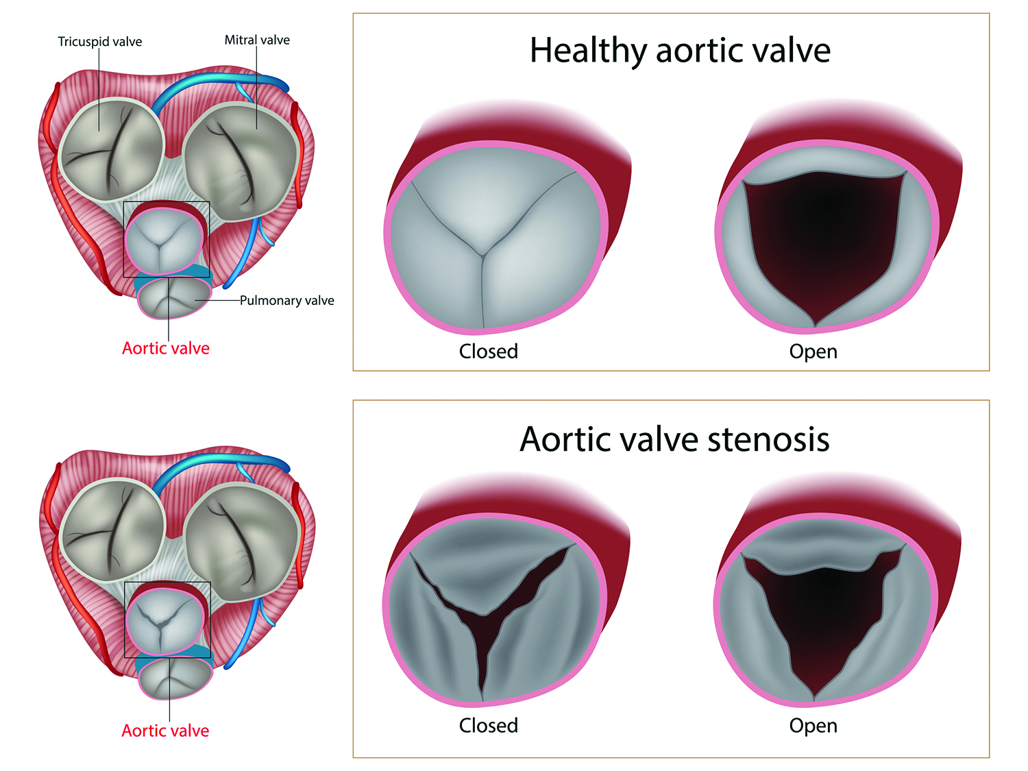 Aortic Valve Stenosis
