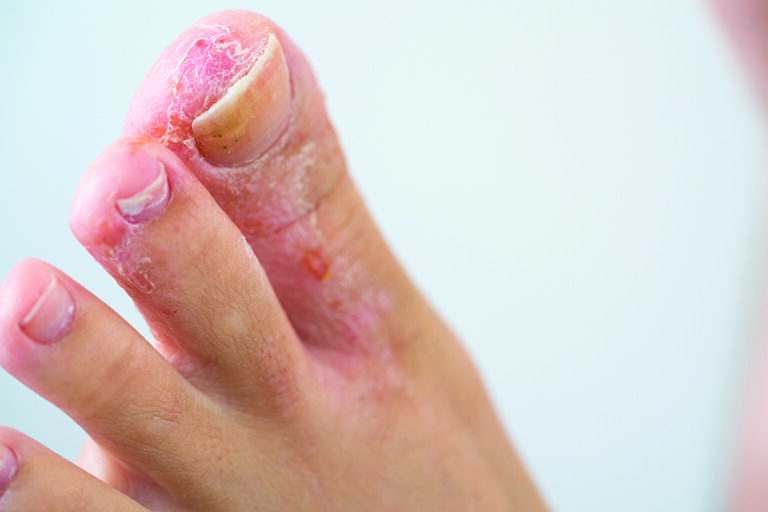 athlete's foot