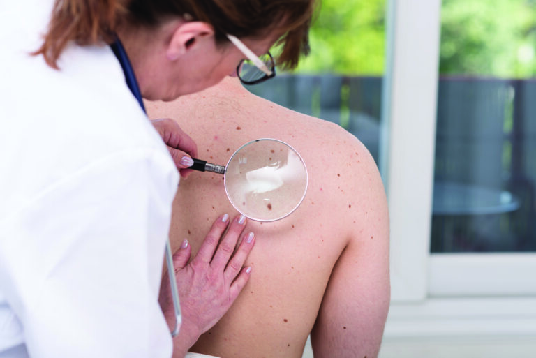 melanoma