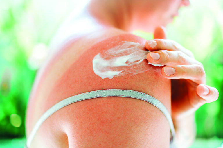 sunburn relief