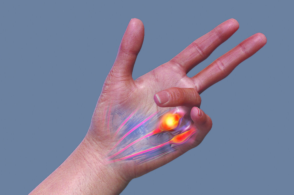 Xiaflex Improves Hand Function - Bottom Line, Inc.