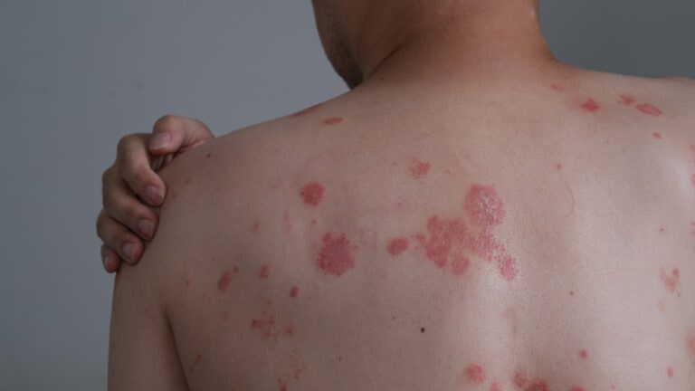 Psoriasis