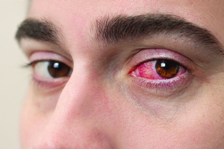 Blepharitis
