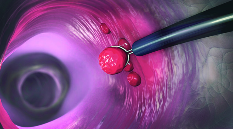 Colonoscopy