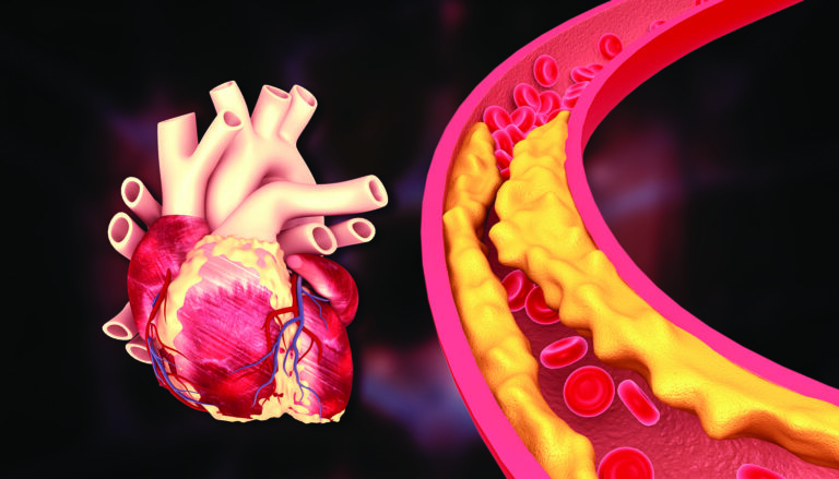 coronary artery calcification