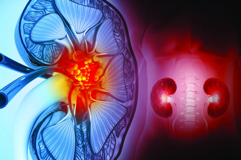 how to prevent kidney stones