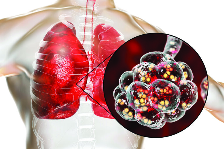 Is Pneumonia Contagious