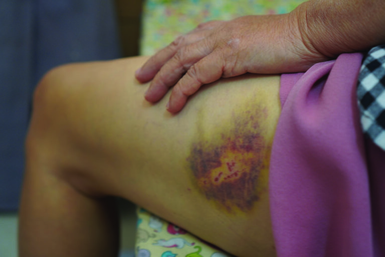 Dangerous Types of Bruises